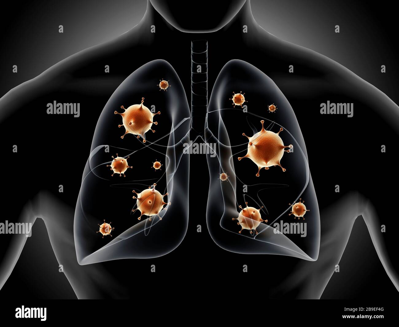 Illustrazione medica che mostra la polmonite nei polmoni umani. Foto Stock