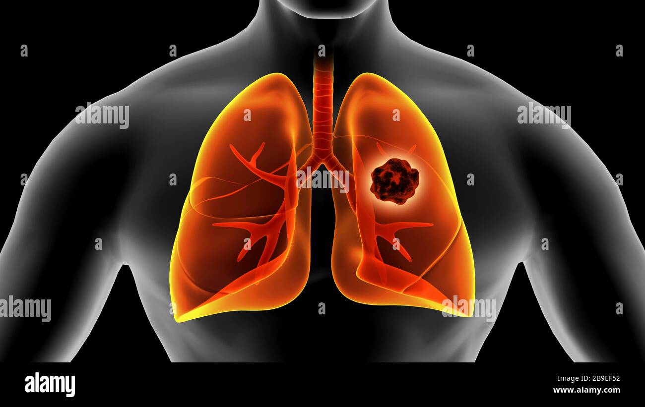 Illustrazione medica del cancro polmonare all'interno dei polmoni umani. Foto Stock