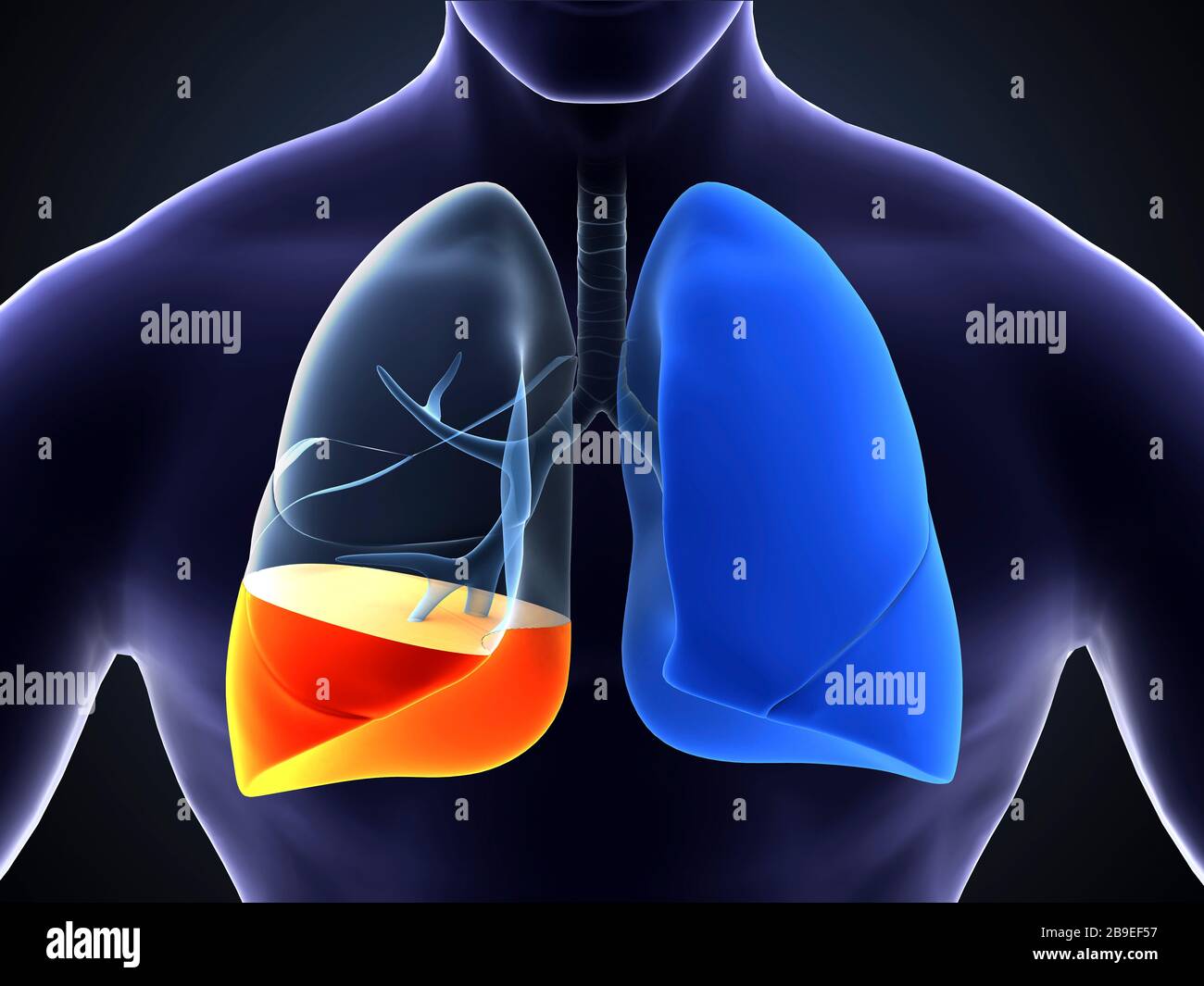 Illustrazione medica che mostra la polmonite nei polmoni umani. Foto Stock