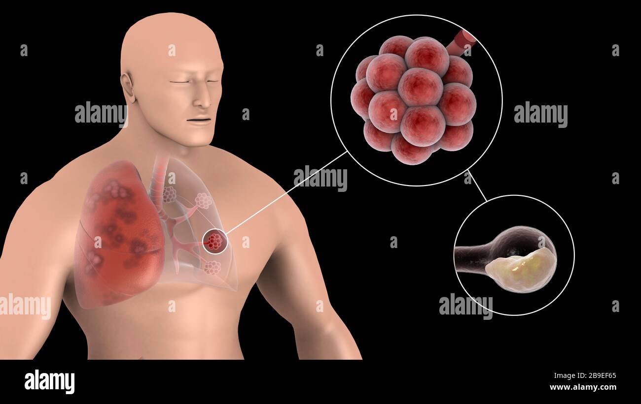 Illustrazione medica che mostra la polmonite nell'alveolo dei polmoni umani. Foto Stock