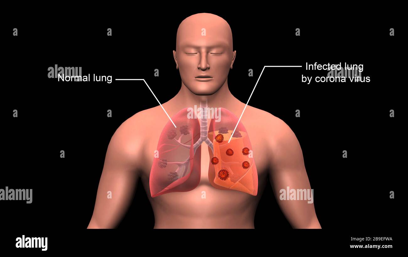COVID-19 coronavirus infettante i polmoni umani, con etichette. Foto Stock