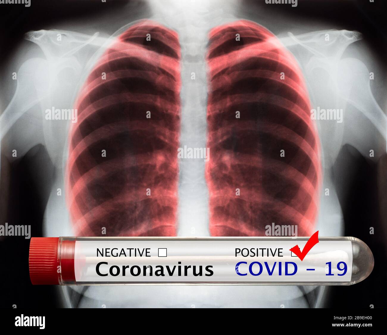 Tubo per analisi del sangue di coronavirus e immagine radiografica del torace umano per una diagnosi medica. Cosid-19 pandemie Foto Stock