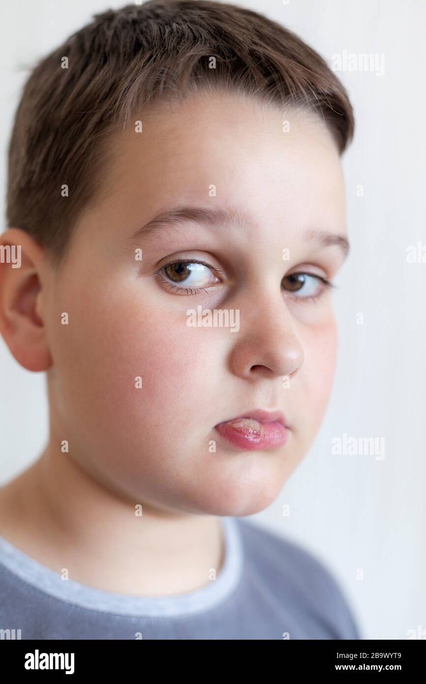 ragazzo malato con grande foschia sulle labbra Foto Stock