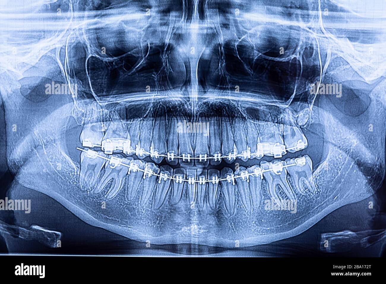 Radiografia dentale con staffe. Radiografia per la raddrizzatura dei denti e la ricerca di strutture dentali. Foto Stock