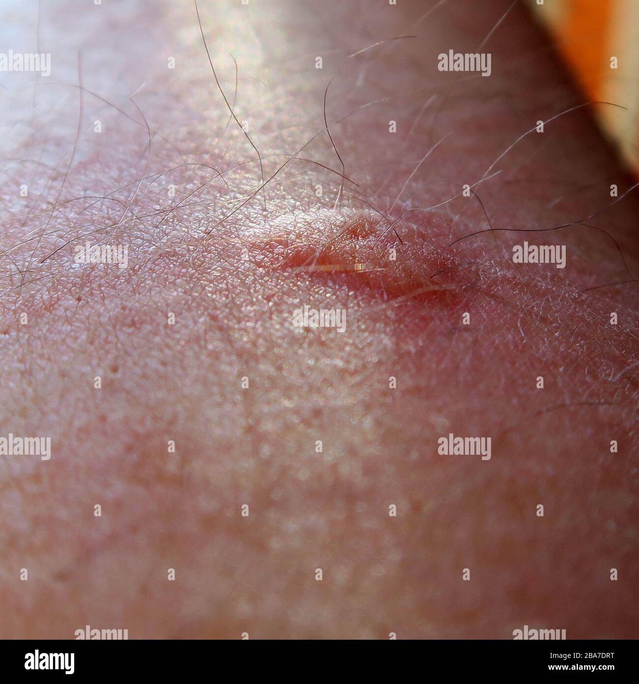 Bee Sting (UK Wild Bee) dopo 20 minuti Foto Stock