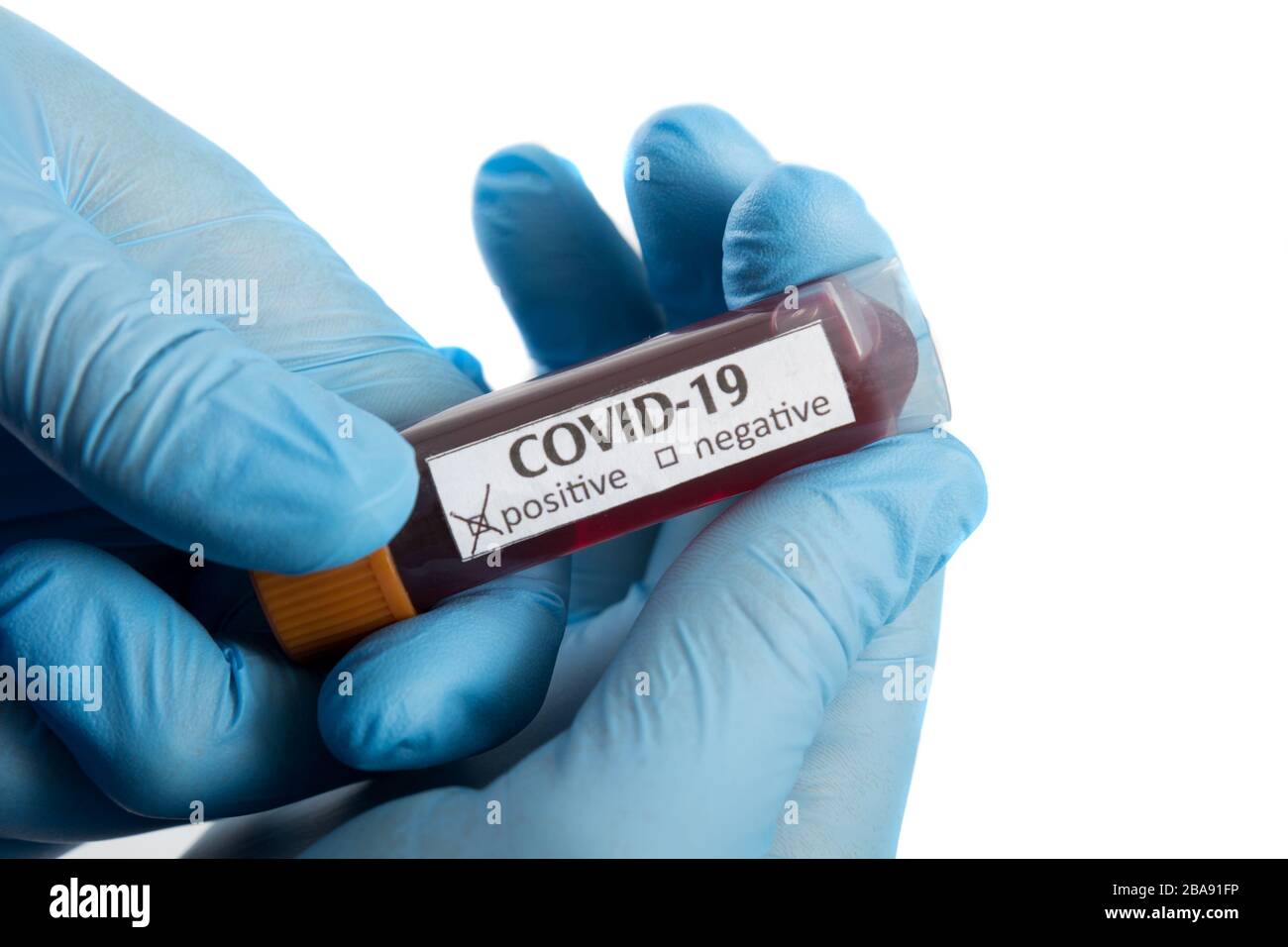 Provetta per analisi del sangue in una mano medica con guanti medici blu. Foto Stock