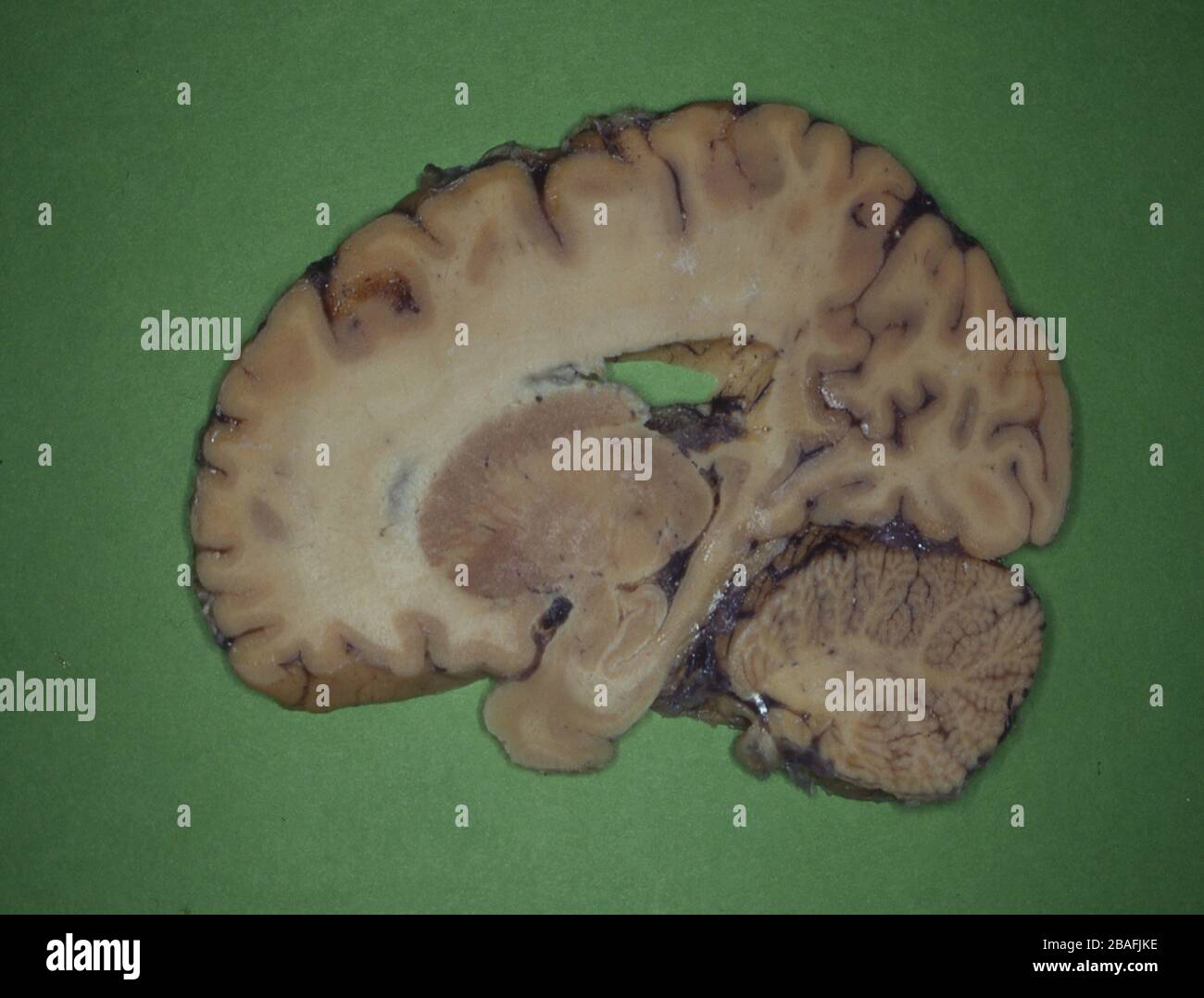 cervello umano affettato con nervi Foto Stock
