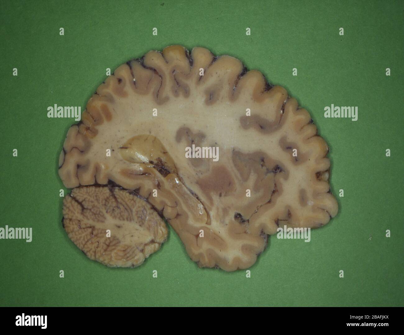 cervello umano affettato con nervi Foto Stock