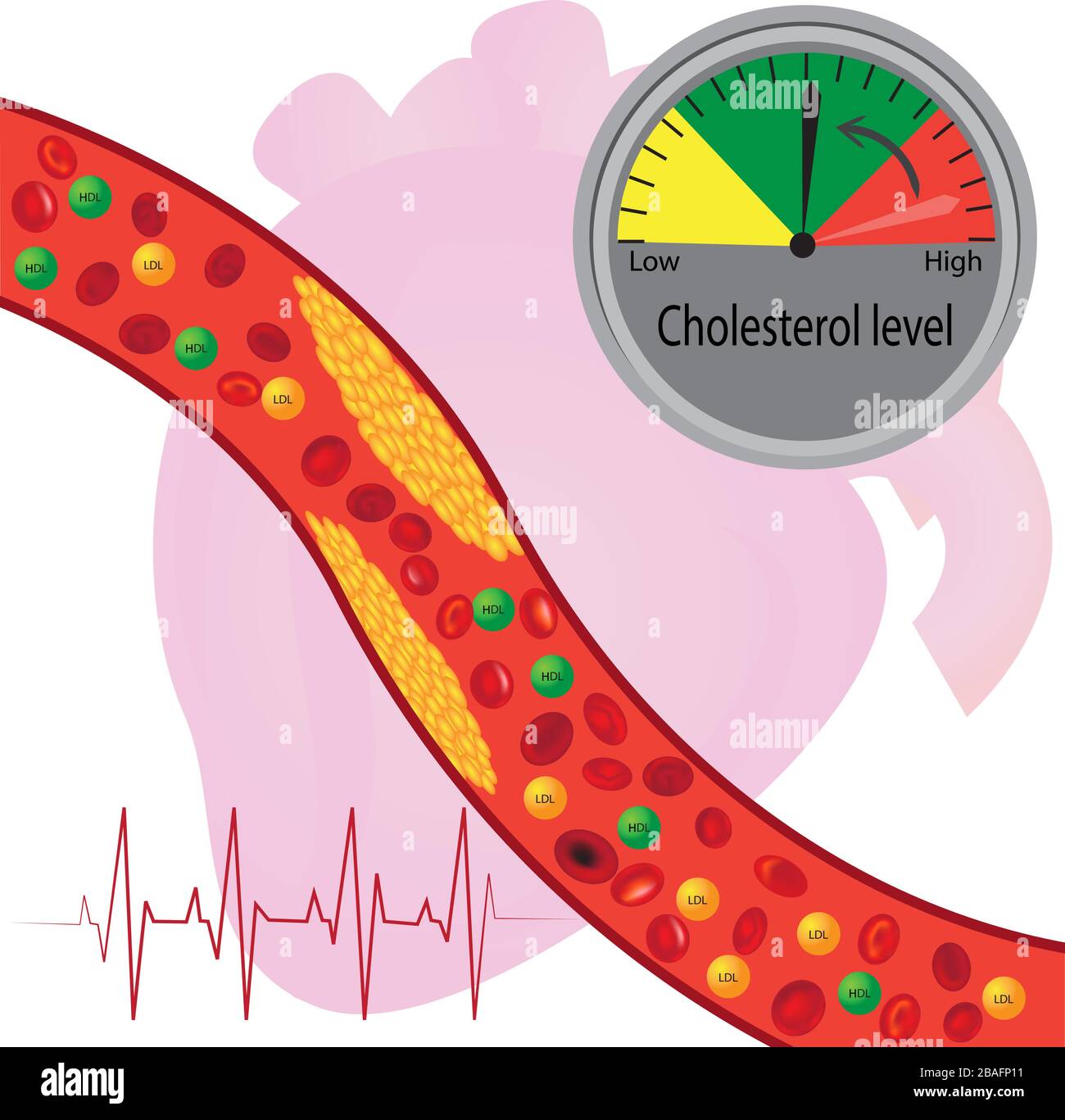 Placca aterosclerotica nei vasi sanguigni, lipidi buoni e cattivi Illustrazione Vettoriale