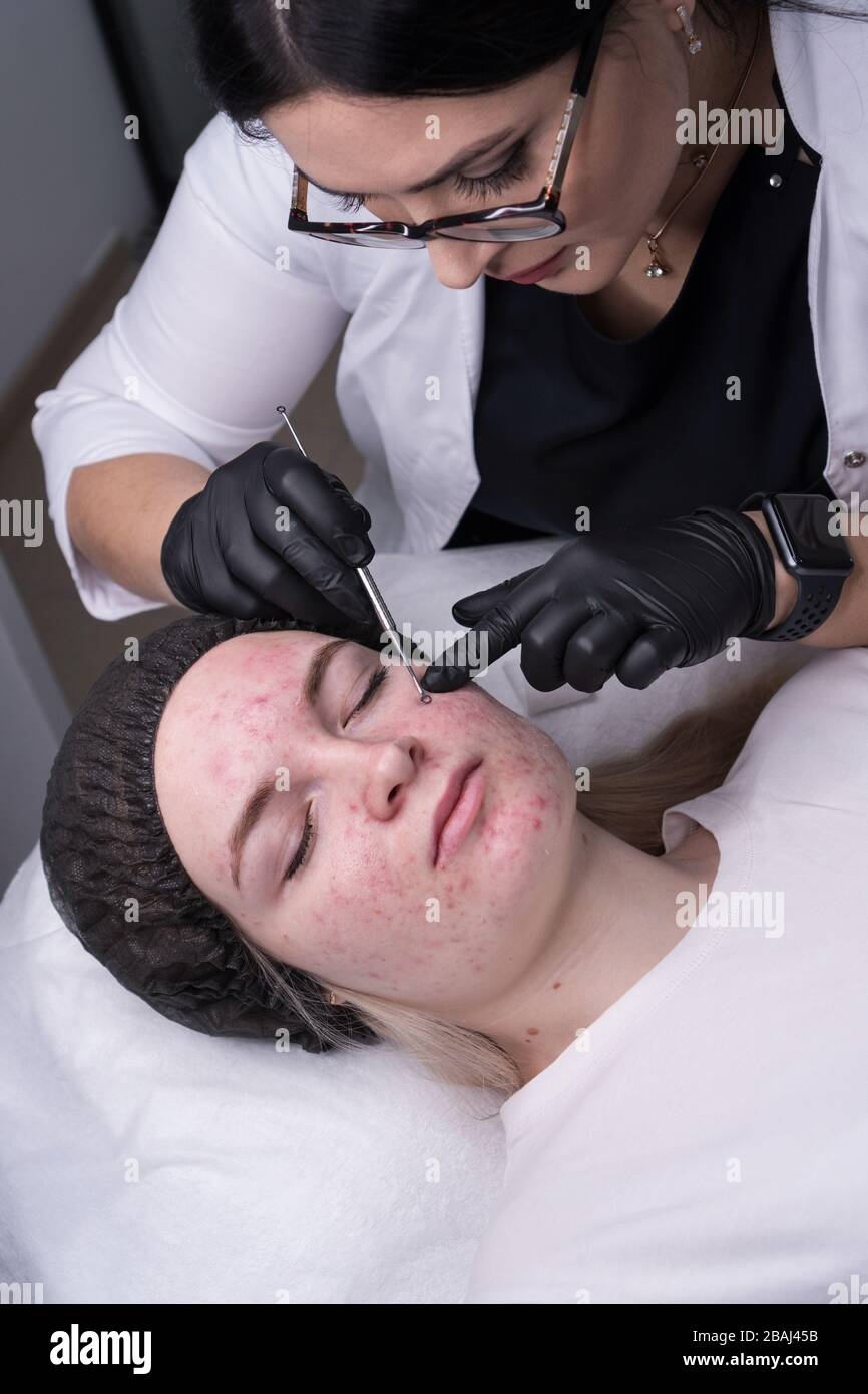 Procedura di pulizia meccanica del viso nel salone di bellezza. Giovane modello che ottiene la cura estetica della pelle del viso e trattamenti in cosmetologist. Trattamento dell'acne. Spa, cosmetologia e relax benessere. Foto Stock