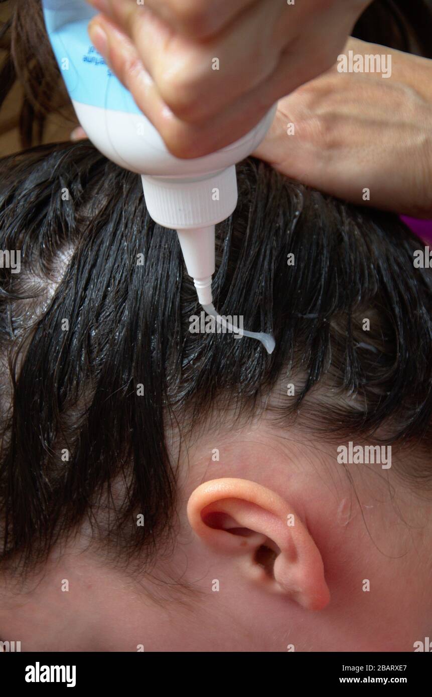 Testa di pidocchi e nits trattamento di infestazione con shampoo medicato. Foto Stock