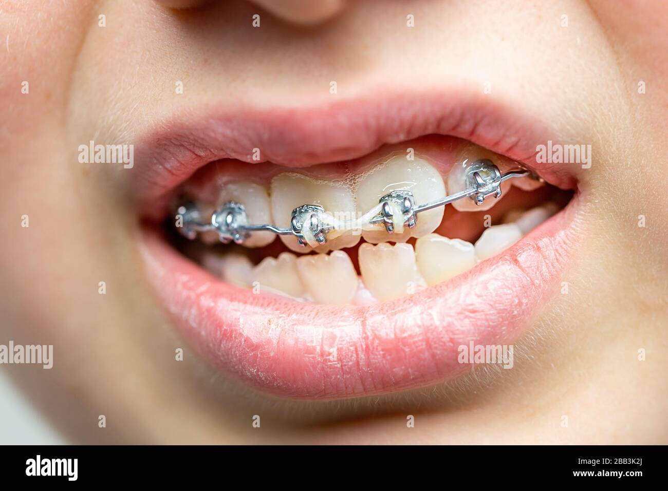 Primo piano sui denti con staffe ortodontiche. Cure dentistiche. Foto Stock