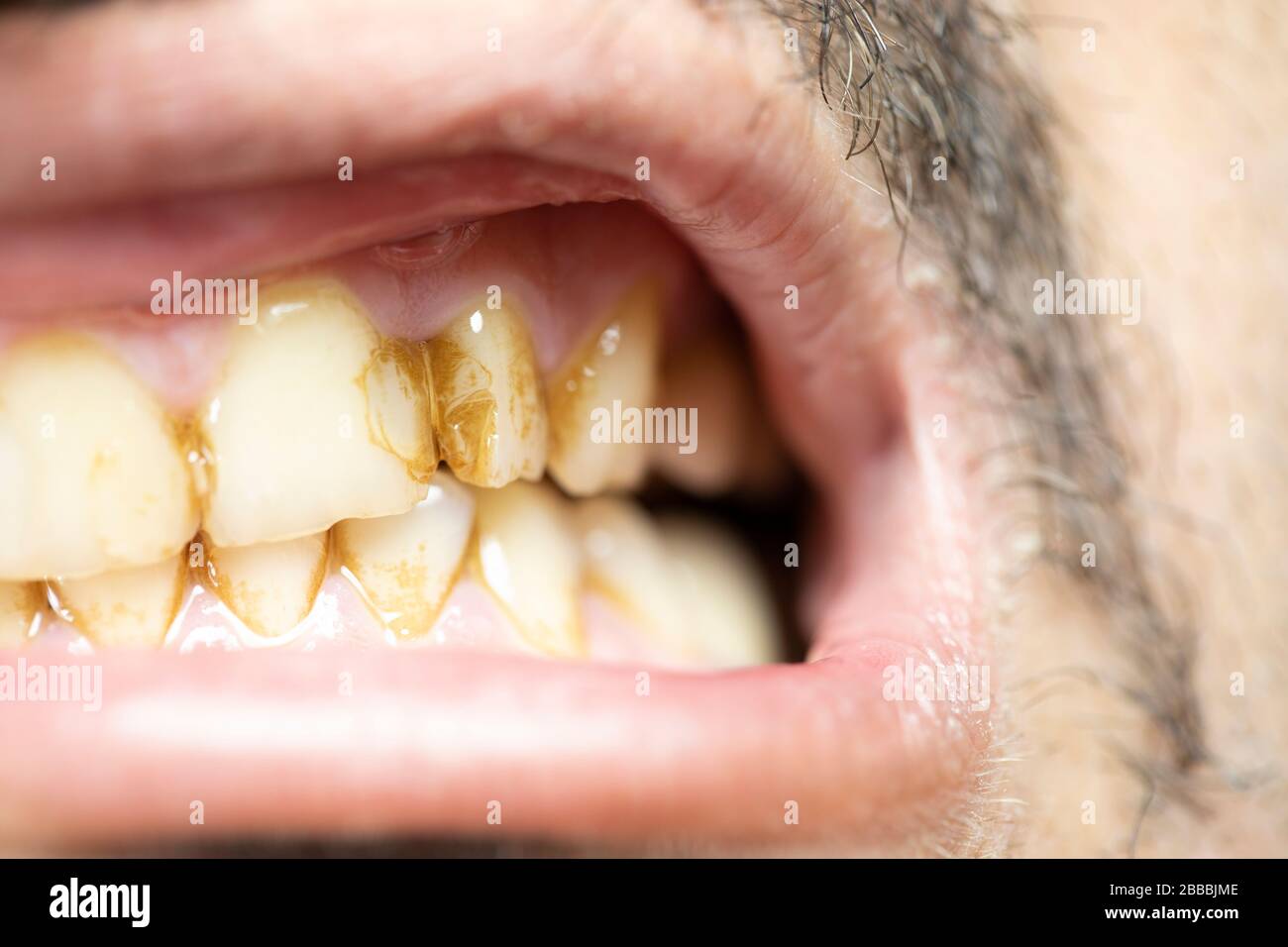 Denti con decorazioni ravvicinate. Ci sono macchie marroni sul dente. Foto Stock