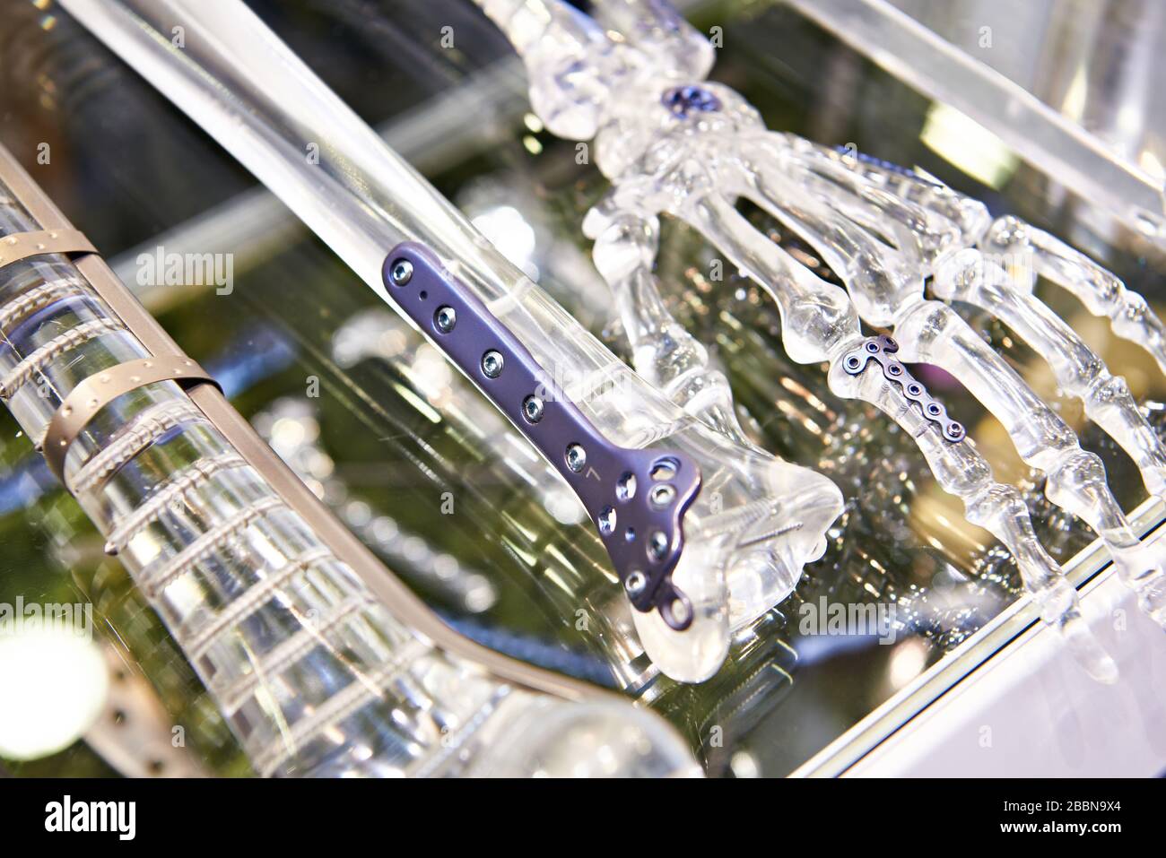Piastre in titanio per la giunzione delle ossa in esposizione Foto Stock