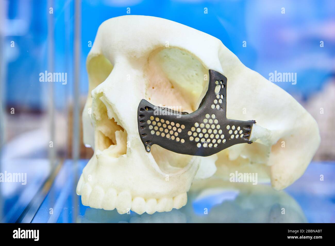 Protesi in lamiera forata sull'osso facciale del cranio Foto Stock