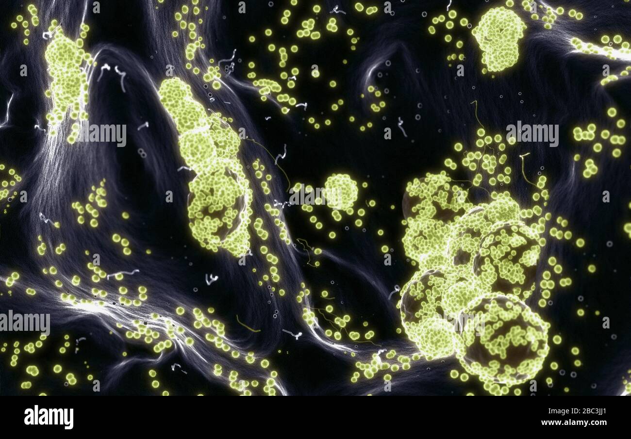 Microscopia elettronica di Coronavirus SARS COVID-19 infestando cellule umane, illlustrazione 3D basata su foto microscopiche elettroniche Foto Stock