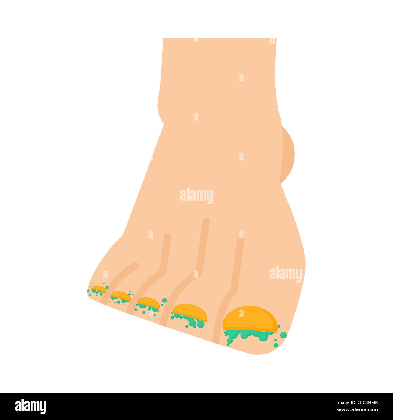 Fungo sulle gambe. Malattia del chiodo. Infezione delle dita del piede. Illustrazione vettoriale Illustrazione Vettoriale