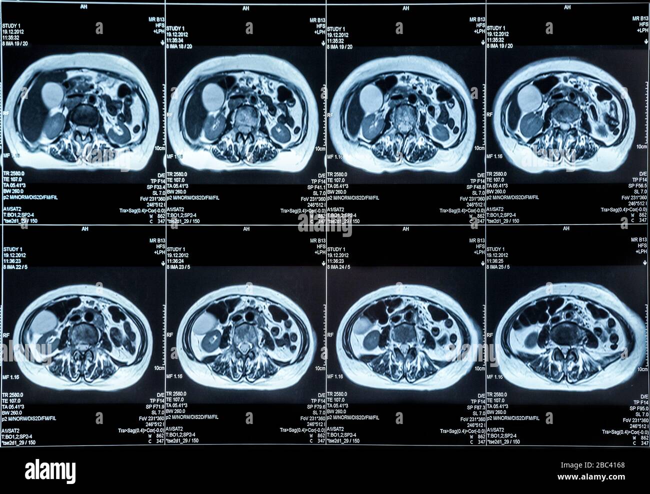 Scansione MRI degli organi dell'addome umano Foto Stock