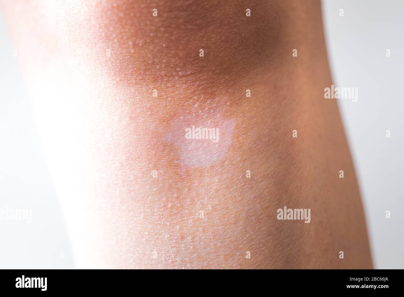 Punto bianco di vitiligo sulla pelle, mancanza di melanina Foto Stock