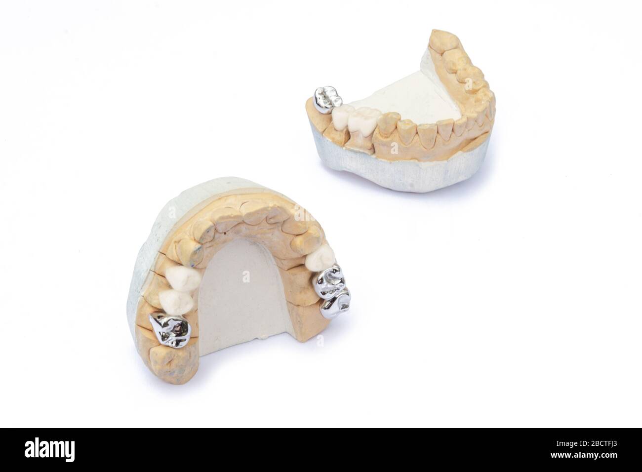 ponti in ceramica-metallo sui modelli delle ganasce superiore e inferiore. protesi di denti danneggiati e mancanti. isolati Foto Stock