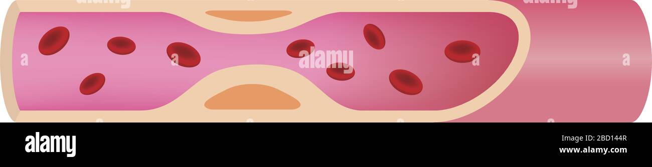 Arteria con arteriosclerosi avanzata illustrazione Illustrazione Vettoriale