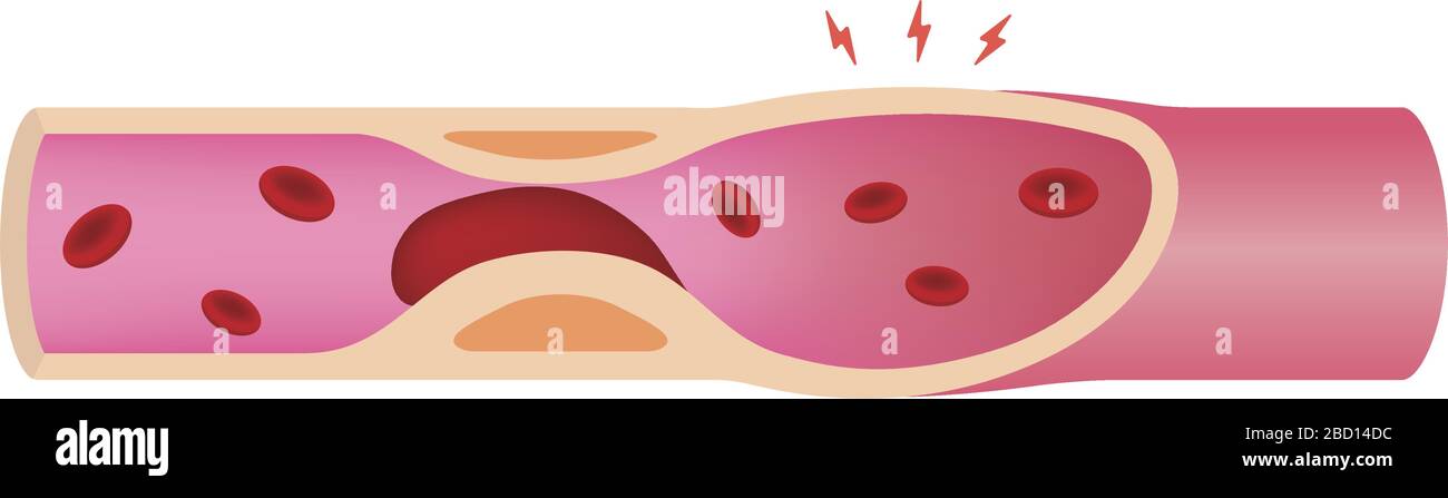 Arteria ostruita con illustrazione del coagulo di sangue Illustrazione Vettoriale