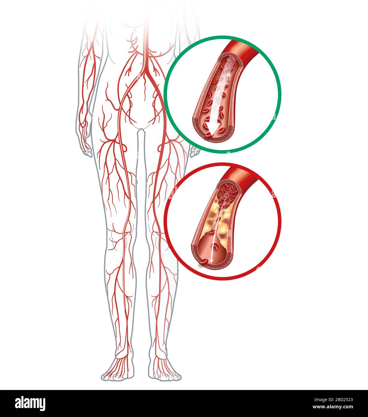 Illustrazione che mostra l'arteria sana e l'arteria arterioslerotica, malattia occlusiva dell'arteria periferica. Foto Stock