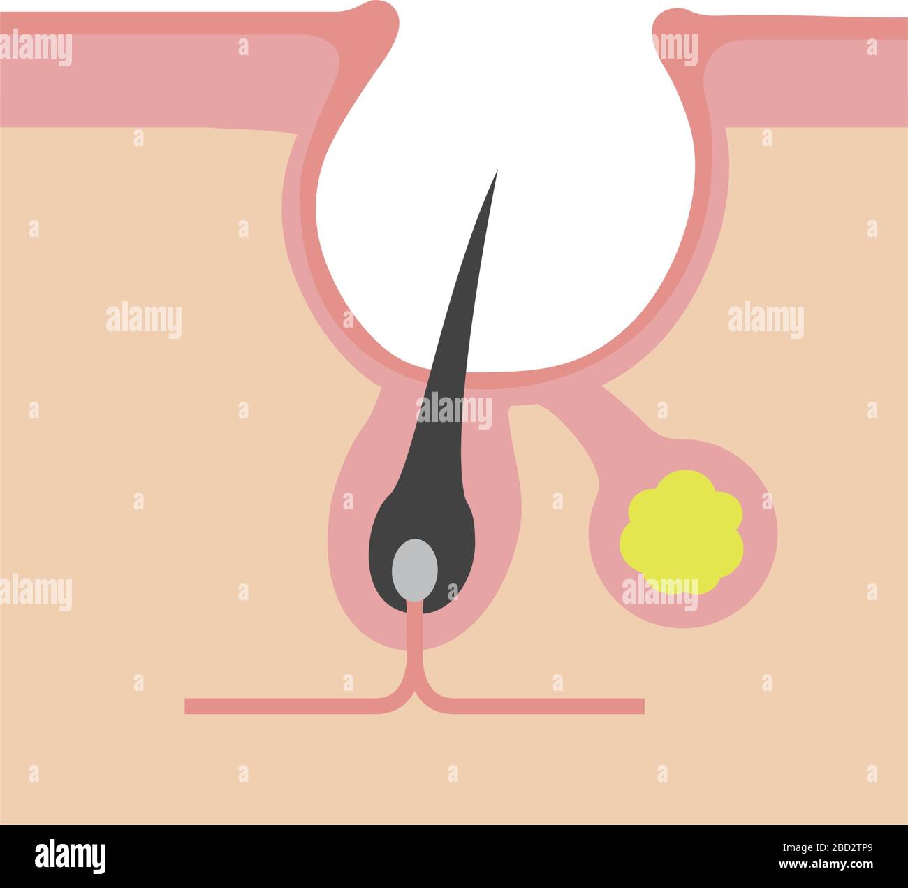 Sezione trasversale dei pori (progressione dell'acne) / Acne cicatrice (cratere) Illustrazione Vettoriale