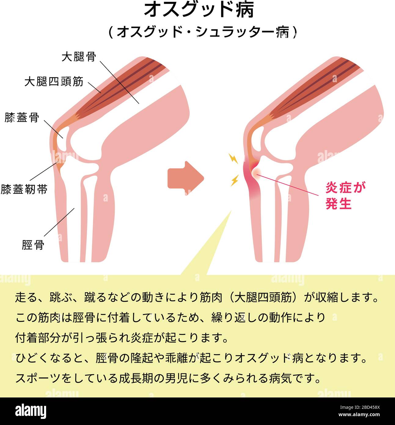 Illustrazione della malattia di Osgood-schlatter (malattia delle articolazioni del ginocchio) Illustrazione Vettoriale