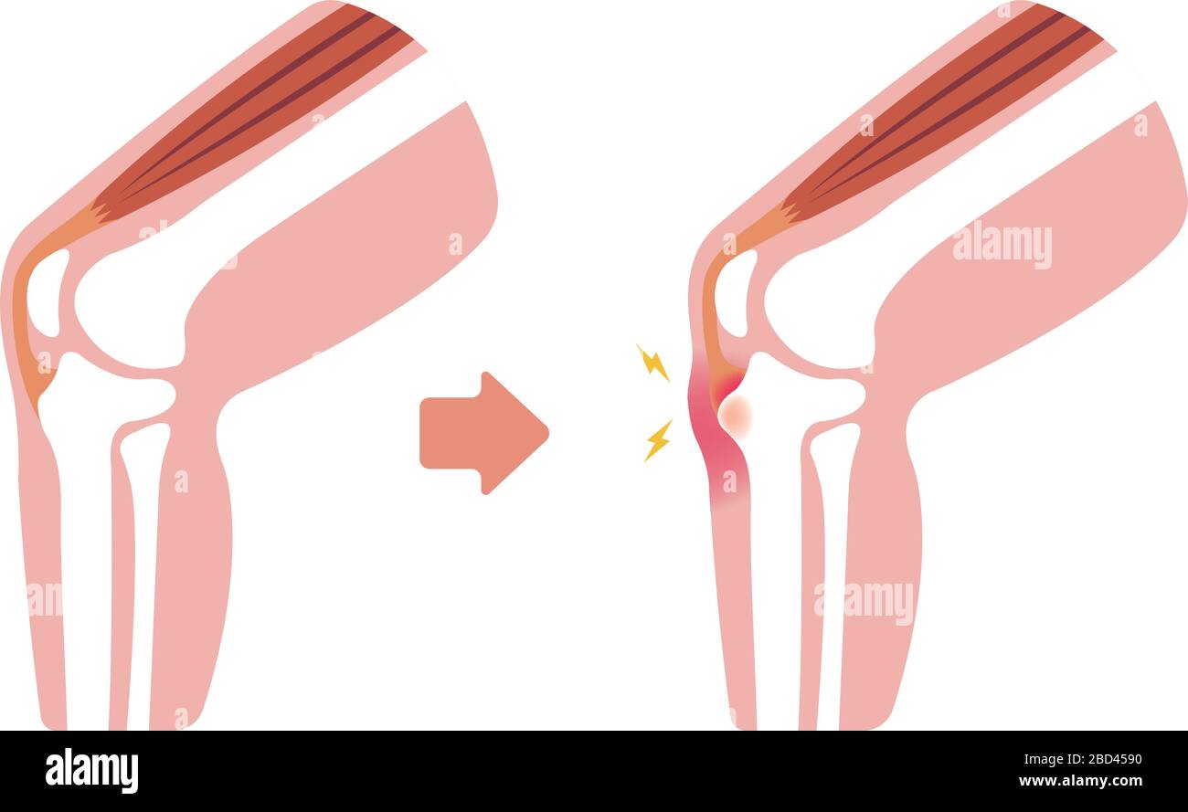 Illustrazione della malattia di Osgood-schlatter (malattia delle articolazioni del ginocchio) Illustrazione Vettoriale