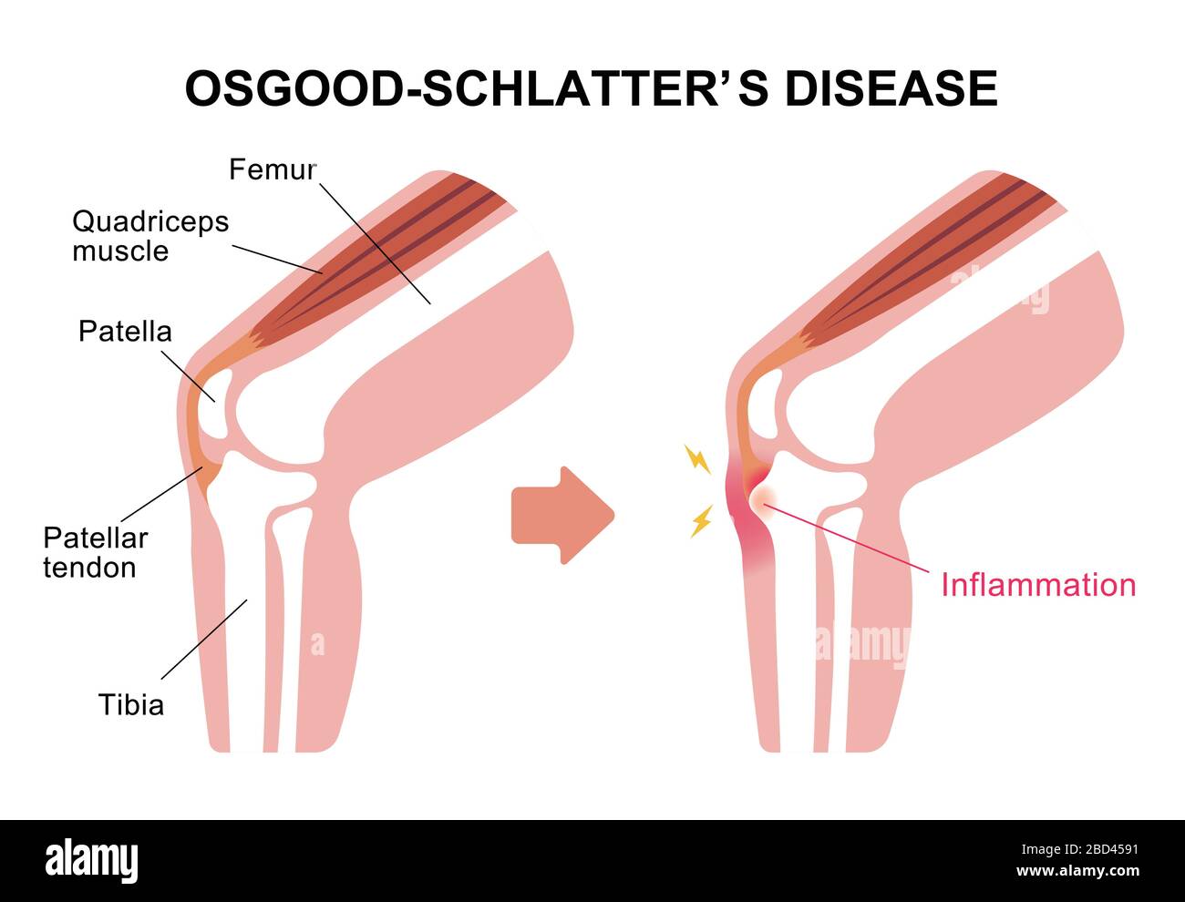 Illustrazione della malattia di Osgood-schlatter (malattia delle articolazioni del ginocchio) Illustrazione Vettoriale