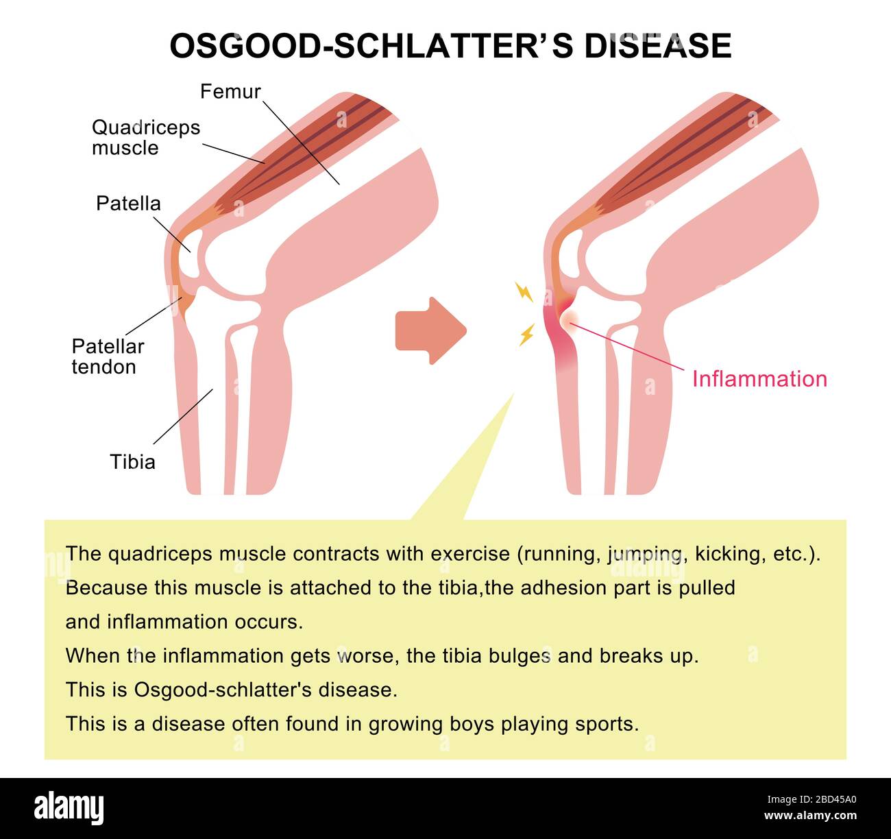 Illustrazione della malattia di Osgood-schlatter (malattia delle articolazioni del ginocchio) Illustrazione Vettoriale