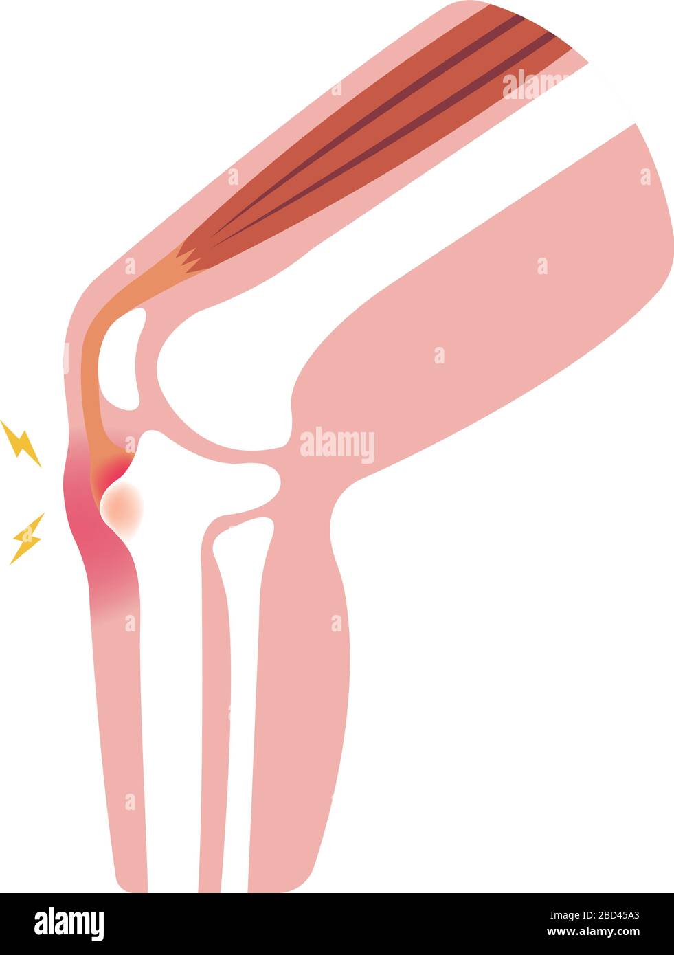 Illustrazione della malattia di Osgood-schlatter (malattia delle articolazioni del ginocchio) Illustrazione Vettoriale