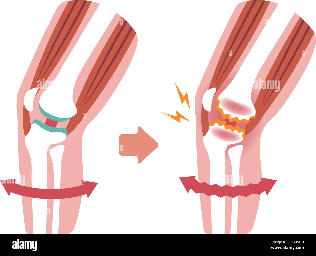 Meccanismo e cause del dolore articolare del ginocchio (gonartrosi / osteoartrite / artrosi del ginocchio ). Illustrazione piatta. Illustrazione Vettoriale