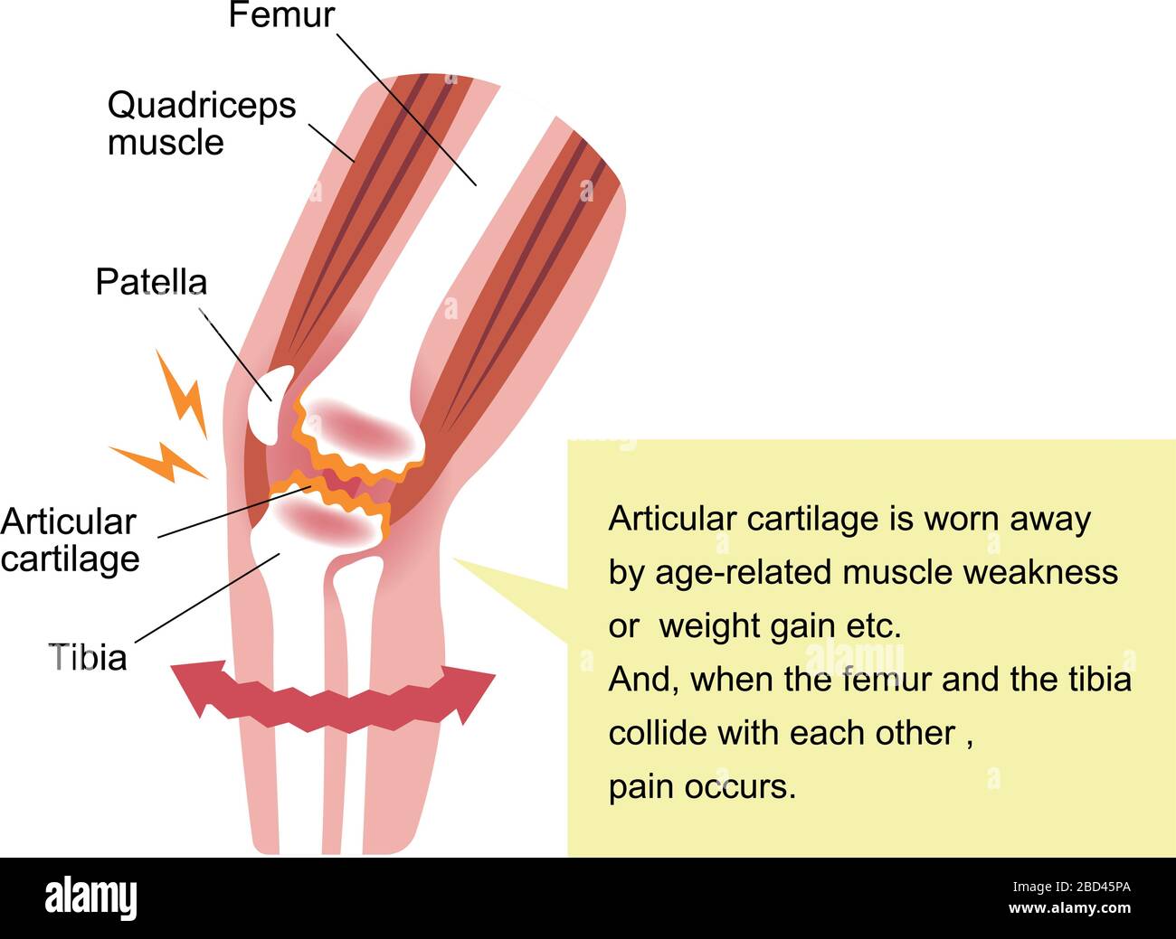 Meccanismo e cause del dolore articolare del ginocchio (gonartrosi / osteoartrite / artrosi del ginocchio ). Illustrazione piatta. Illustrazione Vettoriale