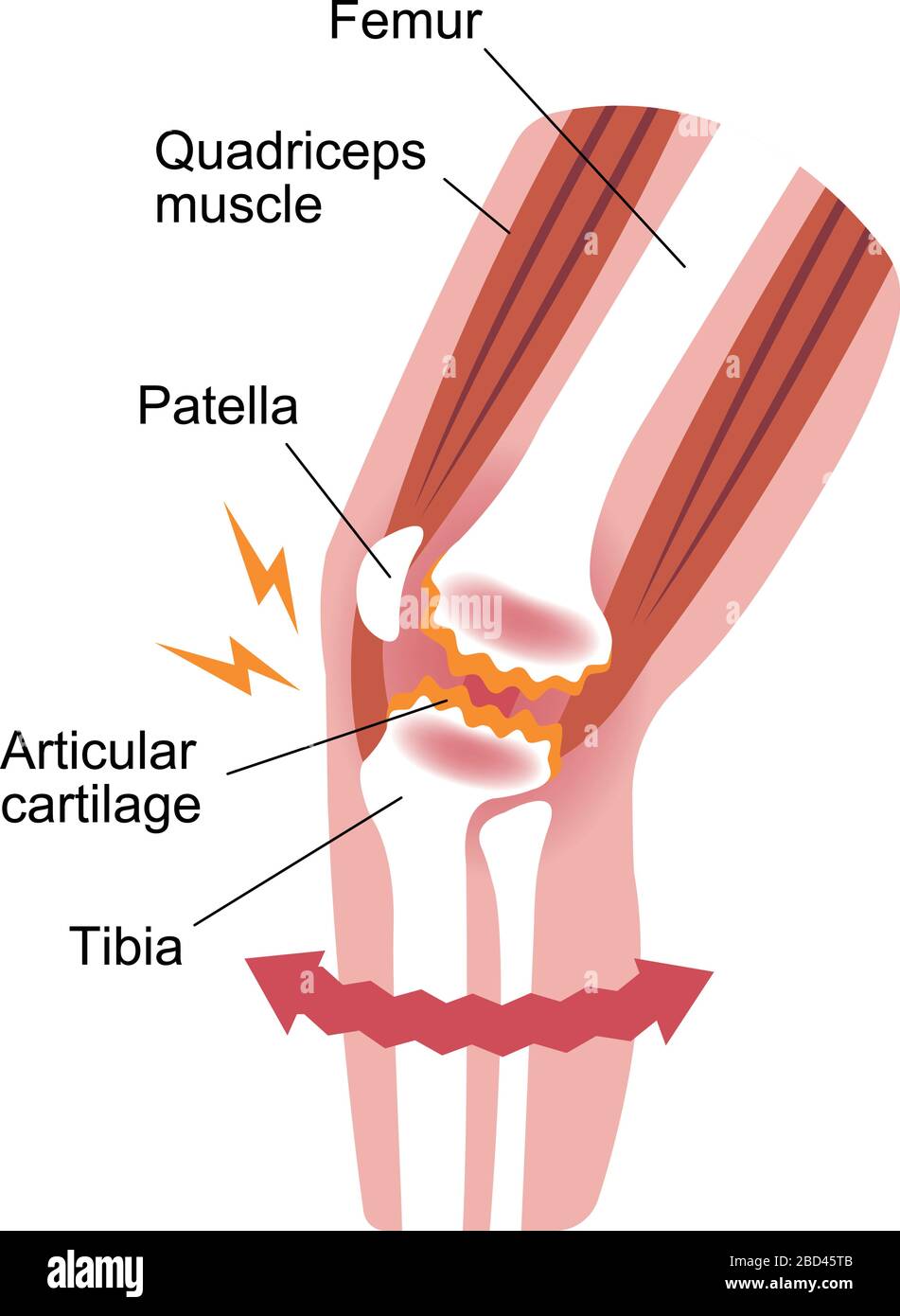 Meccanismo e cause del dolore articolare del ginocchio (gonartrosi / osteoartrite / artrosi del ginocchio ). Illustrazione piatta. Illustrazione Vettoriale