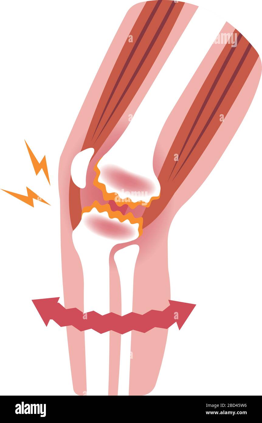 Meccanismo e cause del dolore articolare del ginocchio (gonartrosi / osteoartrite / artrosi del ginocchio ). Illustrazione piatta. Illustrazione Vettoriale