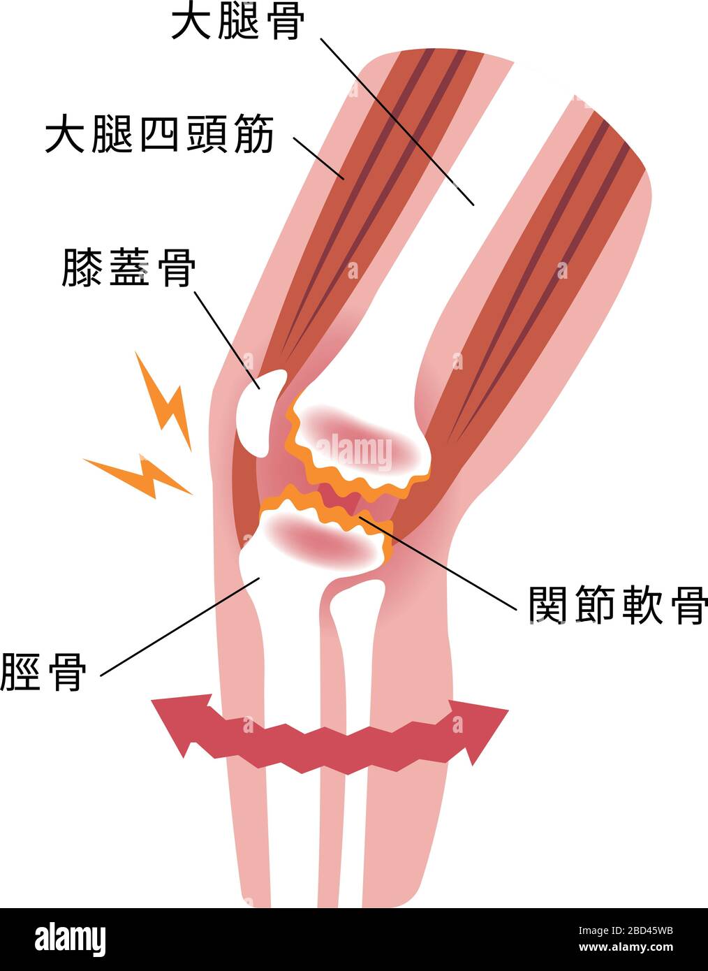 Meccanismo e cause del dolore articolare del ginocchio (gonartrosi / osteoartrite / artrosi del ginocchio ). Illustrazione piatta. Illustrazione Vettoriale