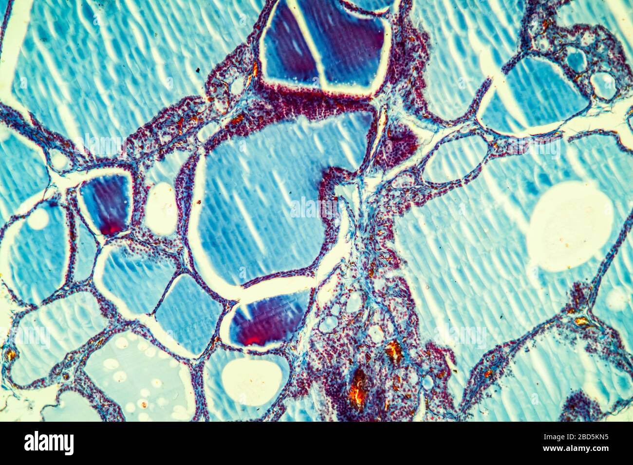 Tessuto tiroideo gozzo con colloide 100x Foto stock - Alamy