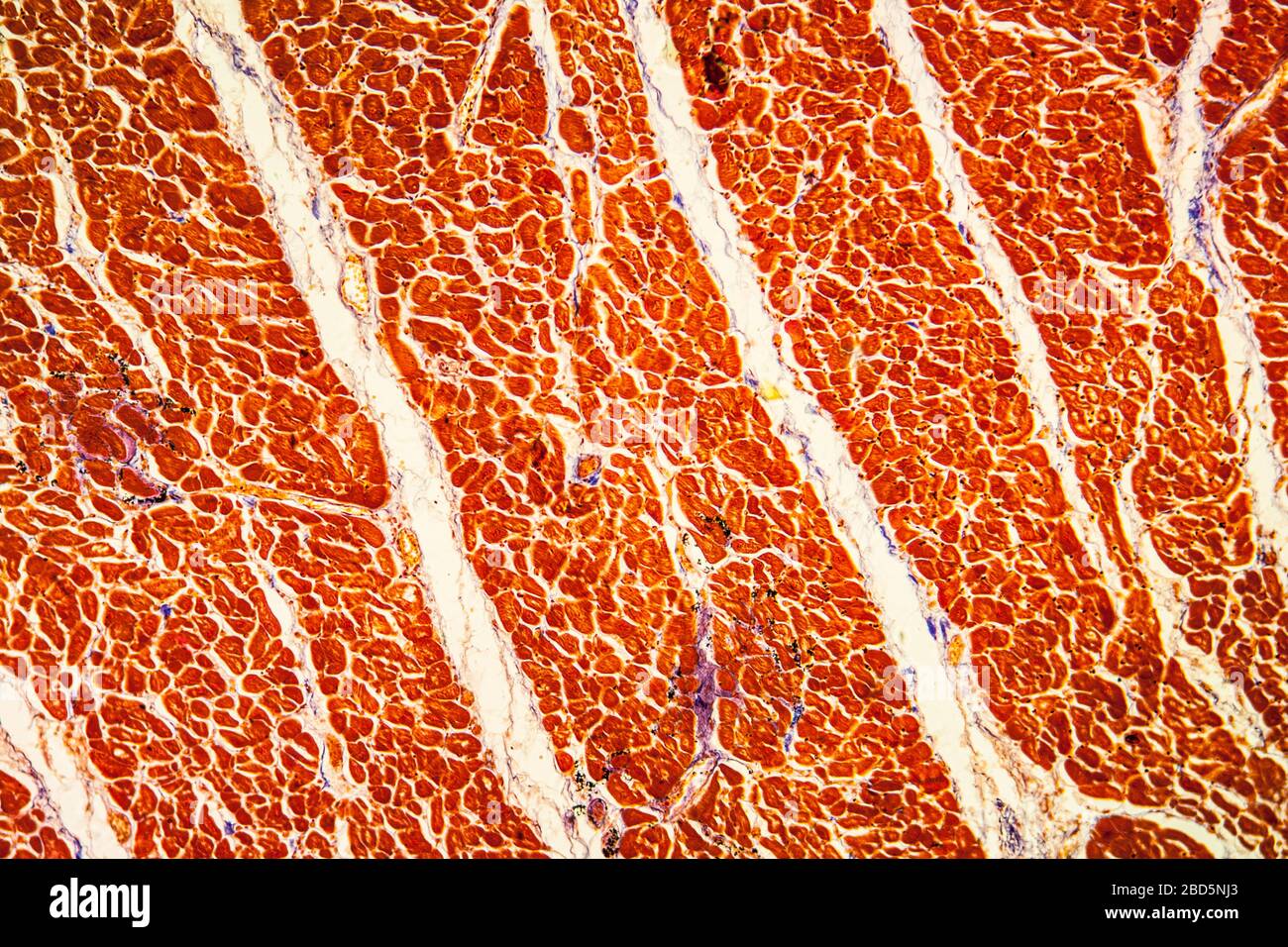 Infiammazione del muscolo cardiaco tessuto malato 100x Foto Stock