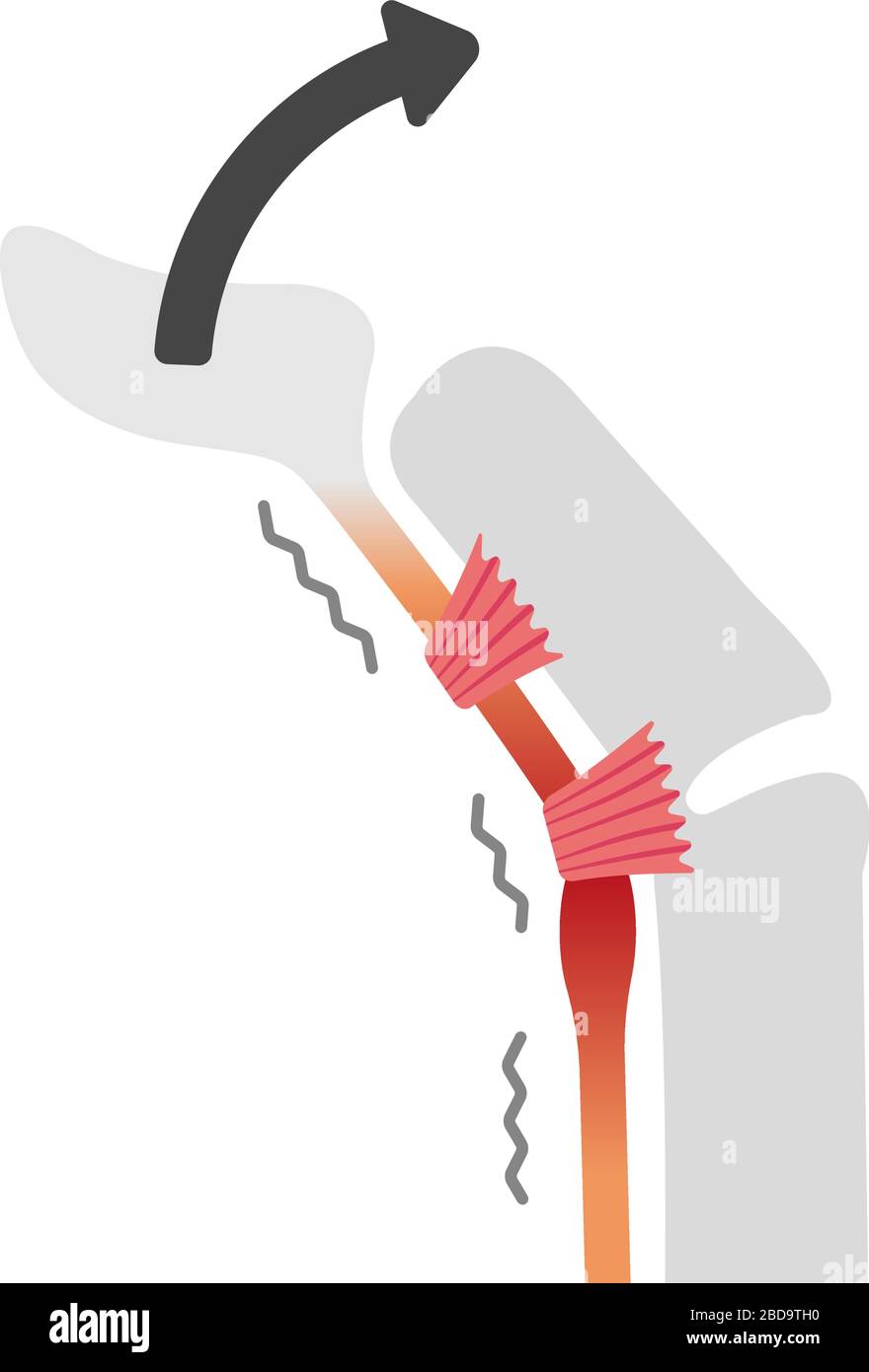 Il dito di attivazione causa e sintomi illustrazione / nessun testo Illustrazione Vettoriale