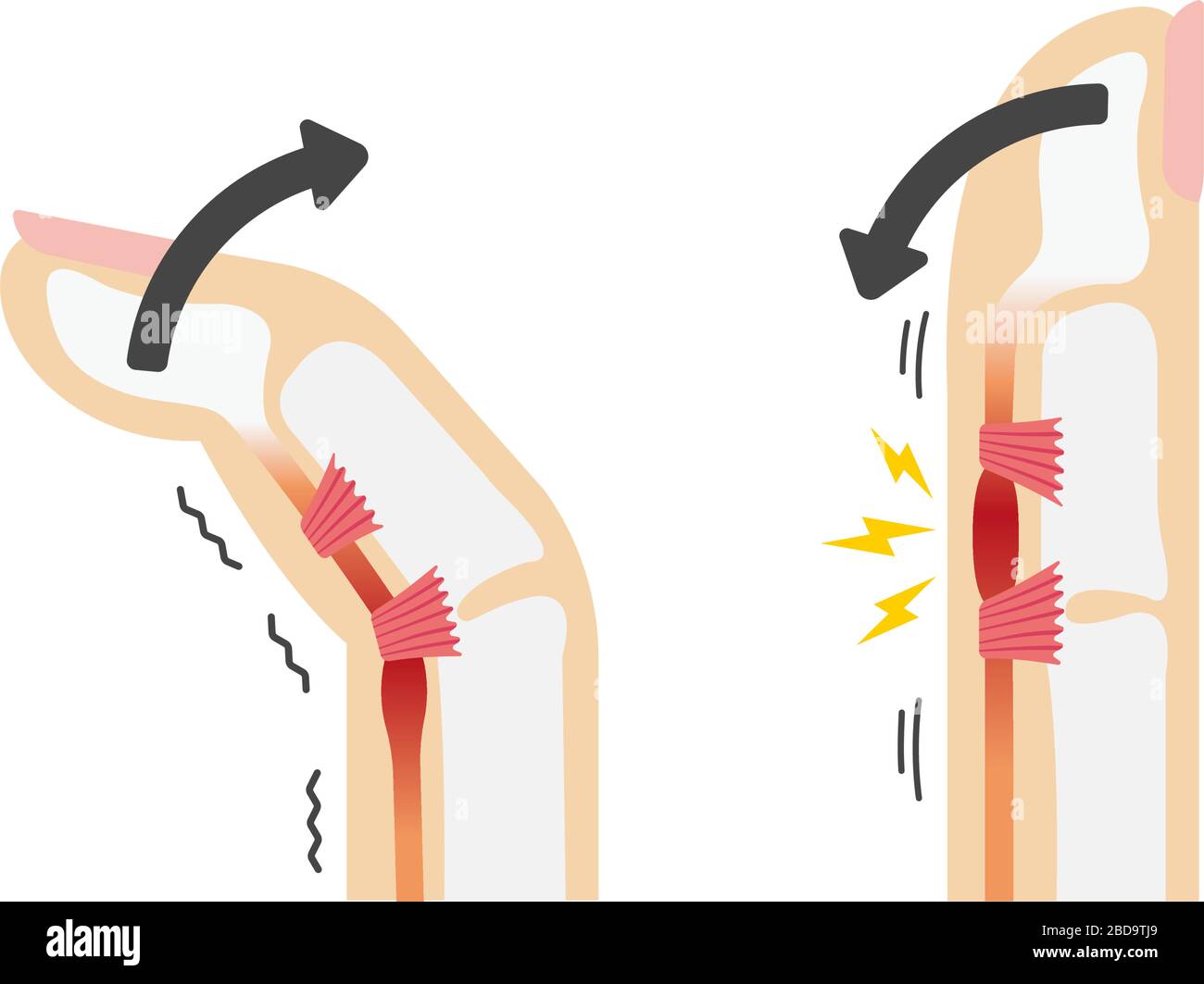 Il dito di attivazione causa e sintomi illustrazione / nessun testo Illustrazione Vettoriale