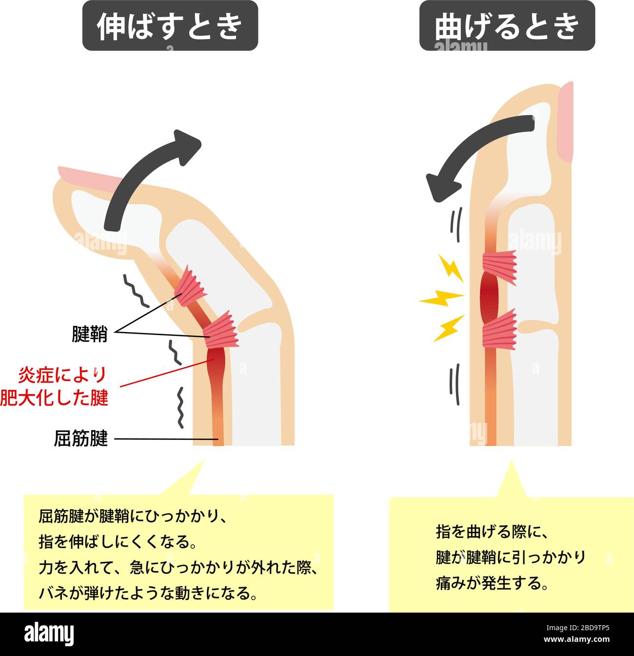 Illustrazione delle cause e dei sintomi del dito di attivazione / giapponese (con testi esplicativi) Illustrazione Vettoriale