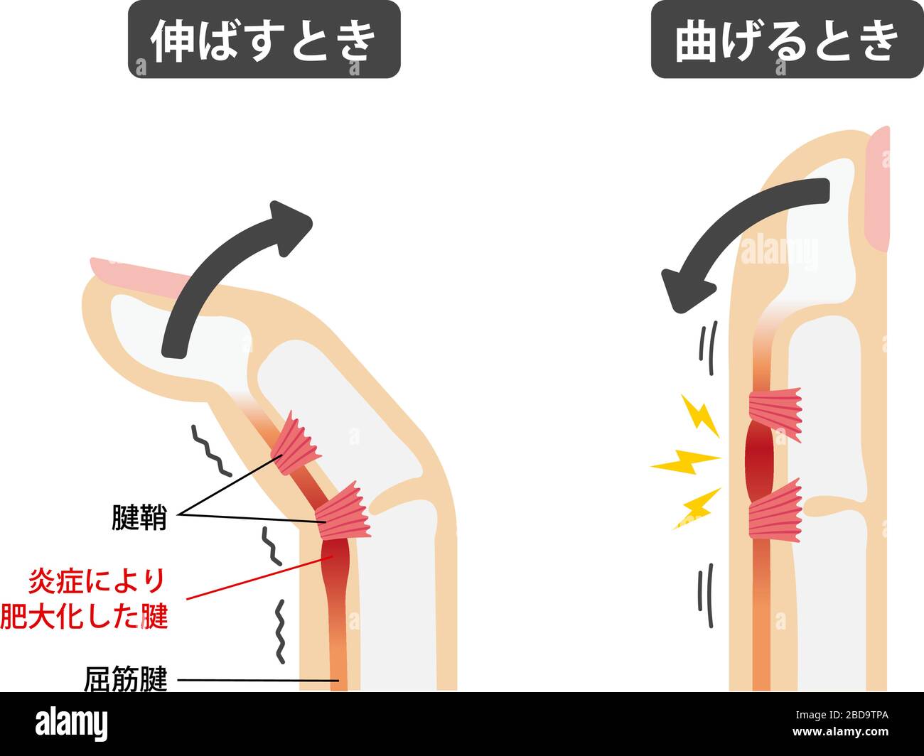 Illustrazione delle cause e dei sintomi del dito di attivazione / giapponese Illustrazione Vettoriale