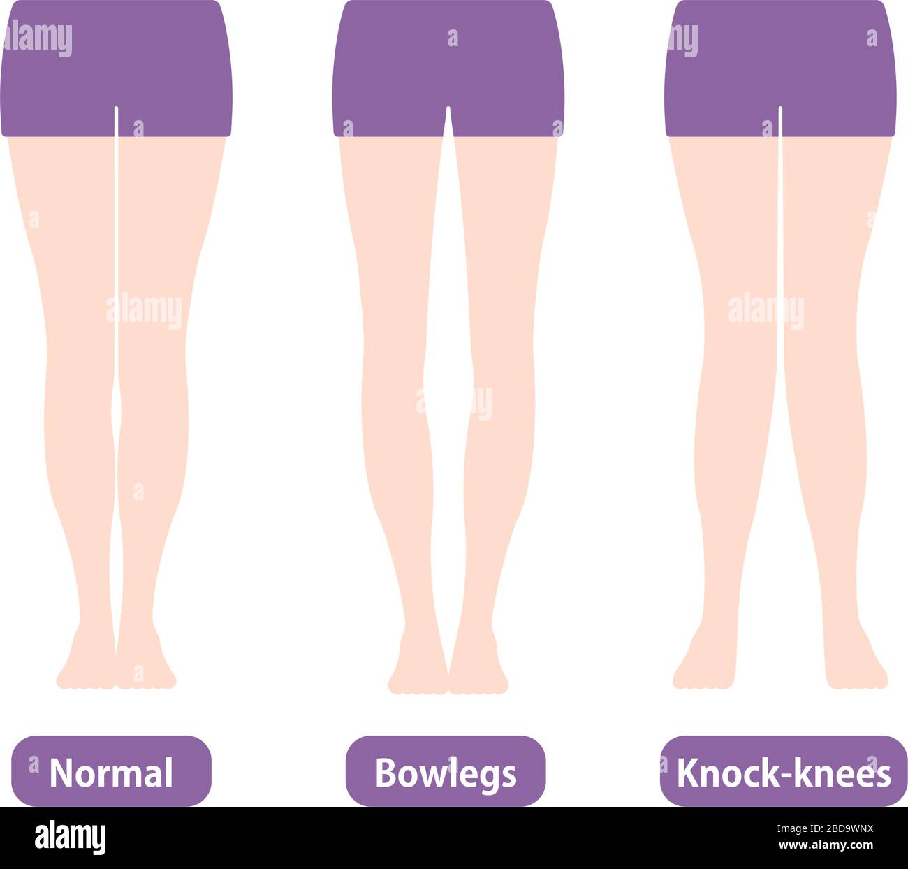 Differenze tipi di angoli delle gambe e ginocchia illustrazione vettoriale . Normale, Bowleg, Knock-knockes. Illustrazione Vettoriale