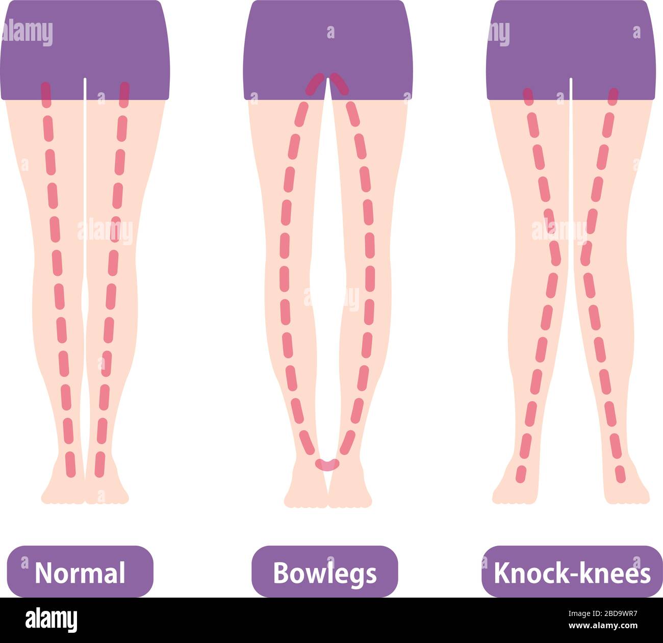 Tipi di differenza di angoli delle gambe e delle ginocchia, illustrazione  vettoriale (giapponese Immagine e Vettoriale - Alamy