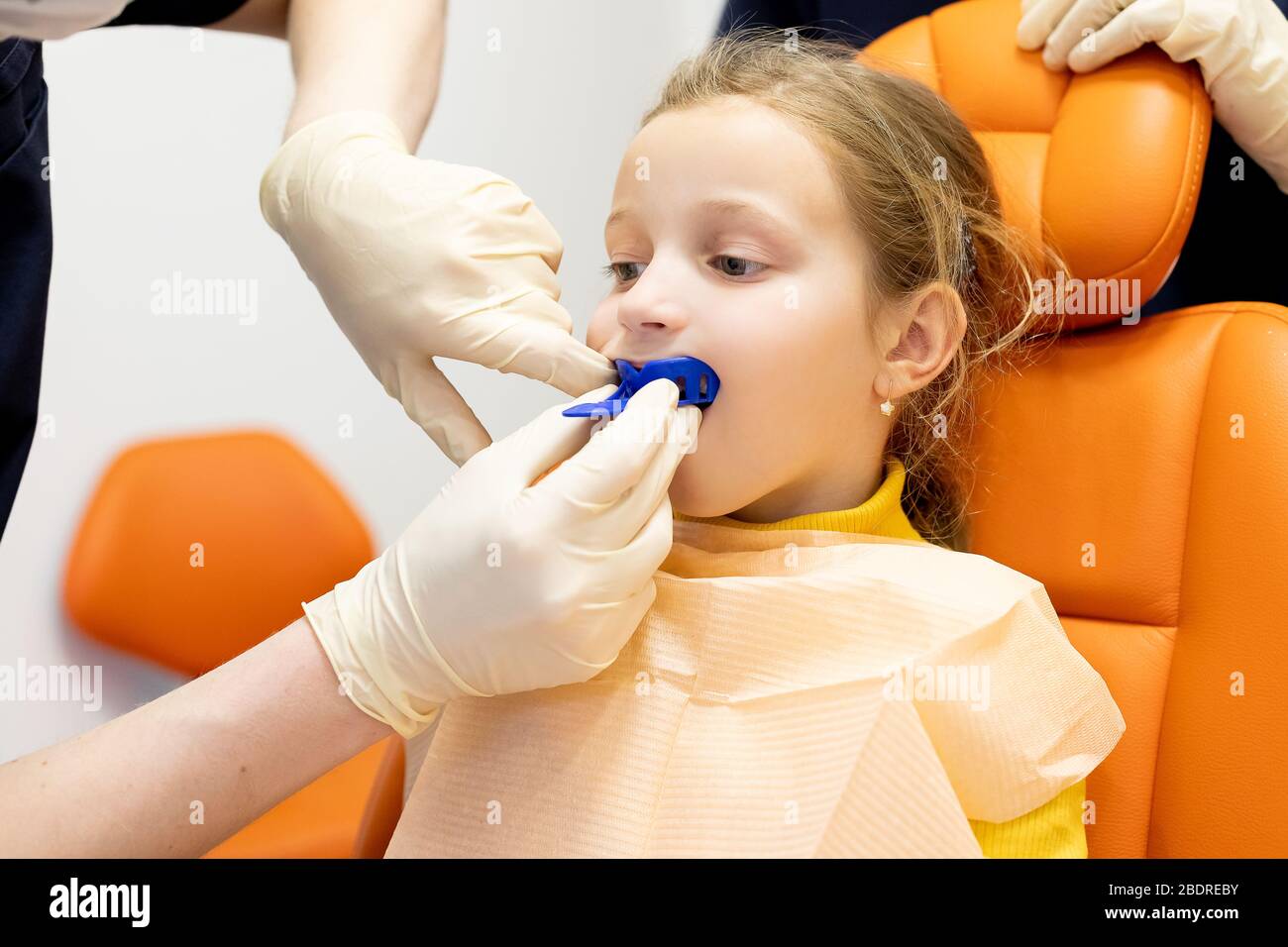 Ortodontista, denti capretti braces, attrezzatura denti cast.disordini dei denti, denti superiori dietro inferiore dents.Blue impronta dentale della tomaia di un bambino Foto Stock