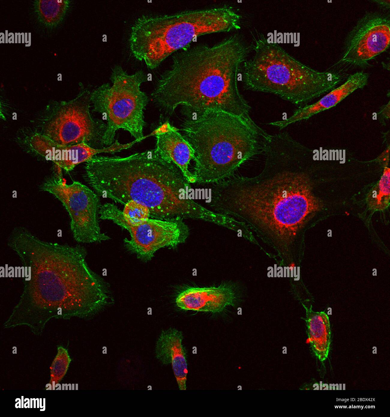 Nanoparticelle di RNA in cellule tumorali Foto Stock