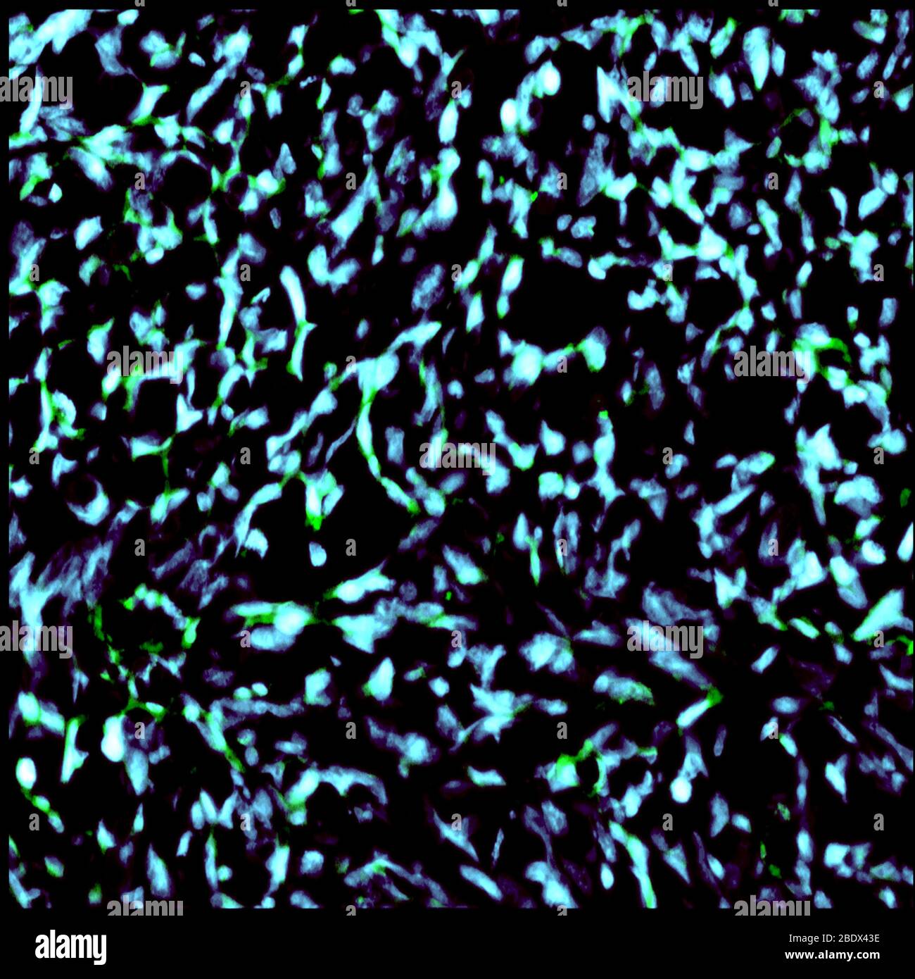 Nanoparticelle nei nuclei cellulari di Glioma Foto Stock