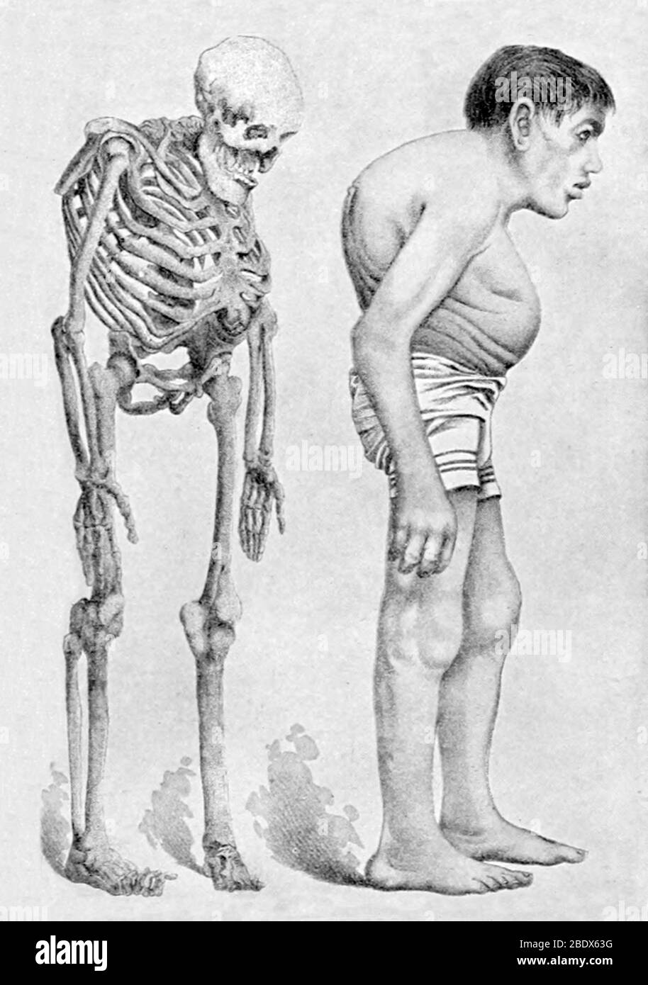 Acromegalia, 1898 Foto Stock